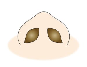 小鼻縮小のノッチイメージ