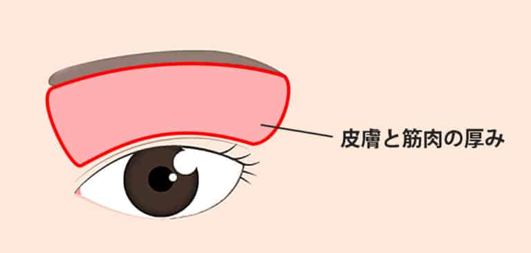 厚ぼったい瞼は脂肪取りをするとすっきりするの？脂肪取り、ROOF切除、眉下切開のどれを受けるべき？