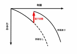 上まぶたのたるみを眉下切開でリセットしたイメージ図