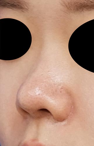 鼻柱基部下降、鼻尖縮小+耳介軟骨移植、鼻翼縮小(内側法+外側法) 半年後 左斜めのAfterの写真