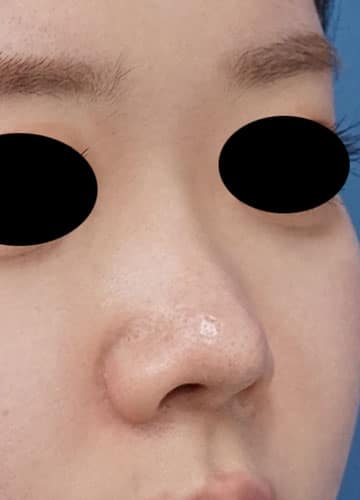 鼻柱基部下降、鼻尖縮小＋耳介軟骨移植、鼻翼縮小(内側法＋外側法)　半年後　右斜めのAfterの写真