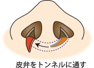フラップ法トンネルに通す