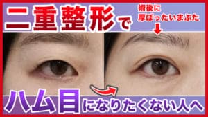 【二重整形】ハム目になりたくない人はまずは眉下切開を行うべき