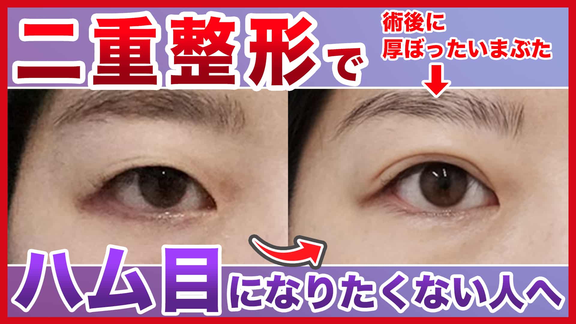 【二重整形】ハム目になりたくない人はまずは眉下切開を行うべき
