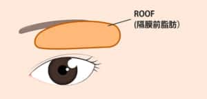 ROOFの厚みの位置