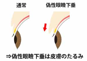 偽性眼瞼下垂（皮膚のたるみ）