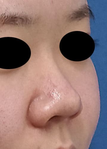 鼻柱基部下降、鼻尖縮小＋耳介軟骨移植、鼻翼縮小(内側法＋外側法)　半年後　右斜めのBefore写真