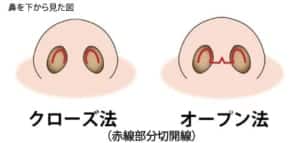 鼻の整形、耳介軟骨移植って？耳介軟骨移植の効果とリスク・失敗について　クローズ法とオープン法