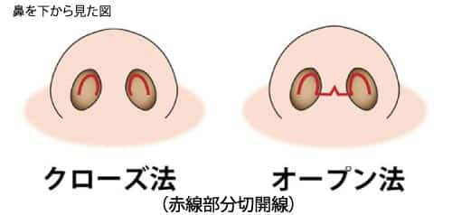 鼻の整形、耳介軟骨移植って？耳介軟骨移植の効果とリスク・失敗について　クローズ法とオープン法