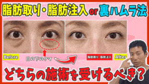 目の下のクマ取り整形は脂肪