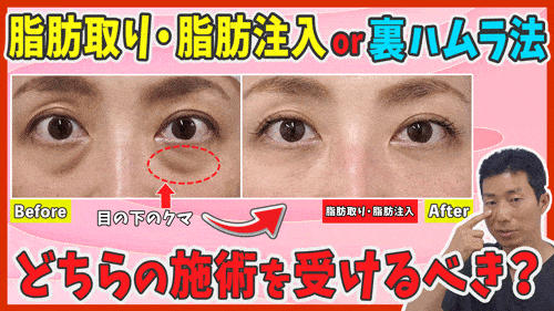 目の下の脂肪とり・脂肪注入と裏ハムラ法はどちらが良い？
