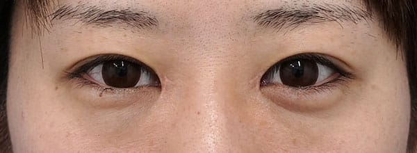 蒙古ひだ形成（逆Ｚ形成）　1ヶ月後のAfterの写真