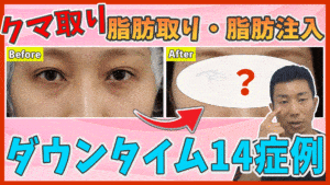 目の下の脂肪取り脂肪注入の
