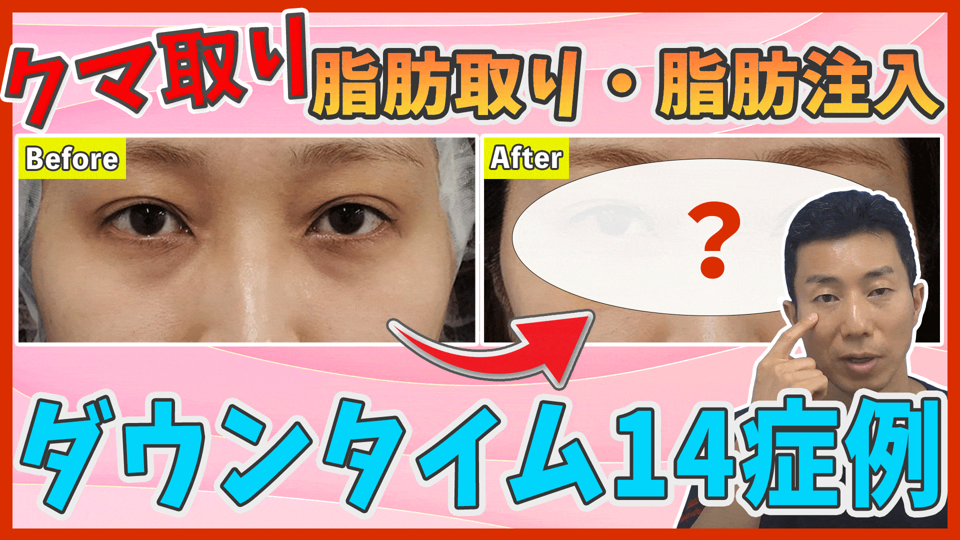 目の下脂肪とり、脂肪注入のダウンタイム