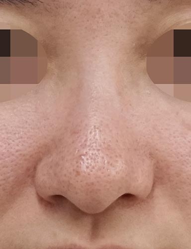 鼻尖縮小(3D法)、ストラット、鼻尖・鼻柱挙上 1ヶ月後 正面のBefore写真