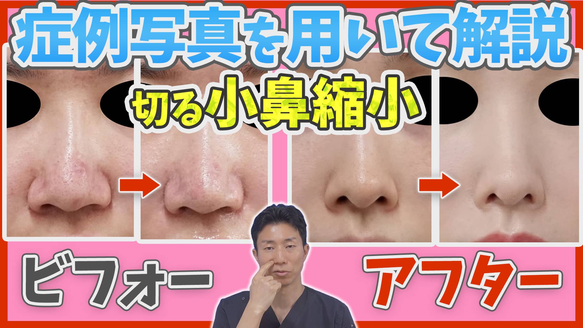切る小鼻縮小のビフォーアフター