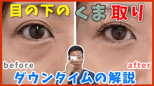 目の下のクマ取りのダウンタイムについて　