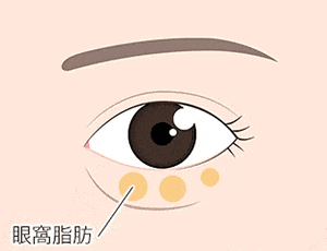 目の下の脂肪