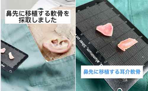 耳介軟骨移植はどこから軟骨を採取する？耳の傷は目立たない？　耳介軟骨採取写真