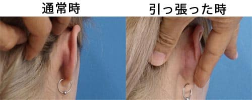 耳介軟骨移植はどこから軟骨を採取する？耳の傷は目立たない？　軟骨採取後の傷写真