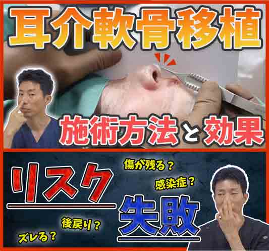 鼻の整形手術、耳介軟骨移植って？耳介軟骨移植の効果とリスク・失敗について医師が解説