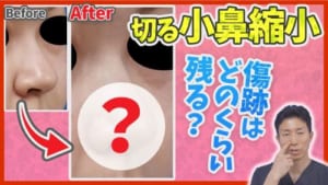 切る小鼻縮小の傷跡についてのサムネイル