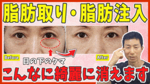 目の下脂肪取り+脂肪注入　メリット