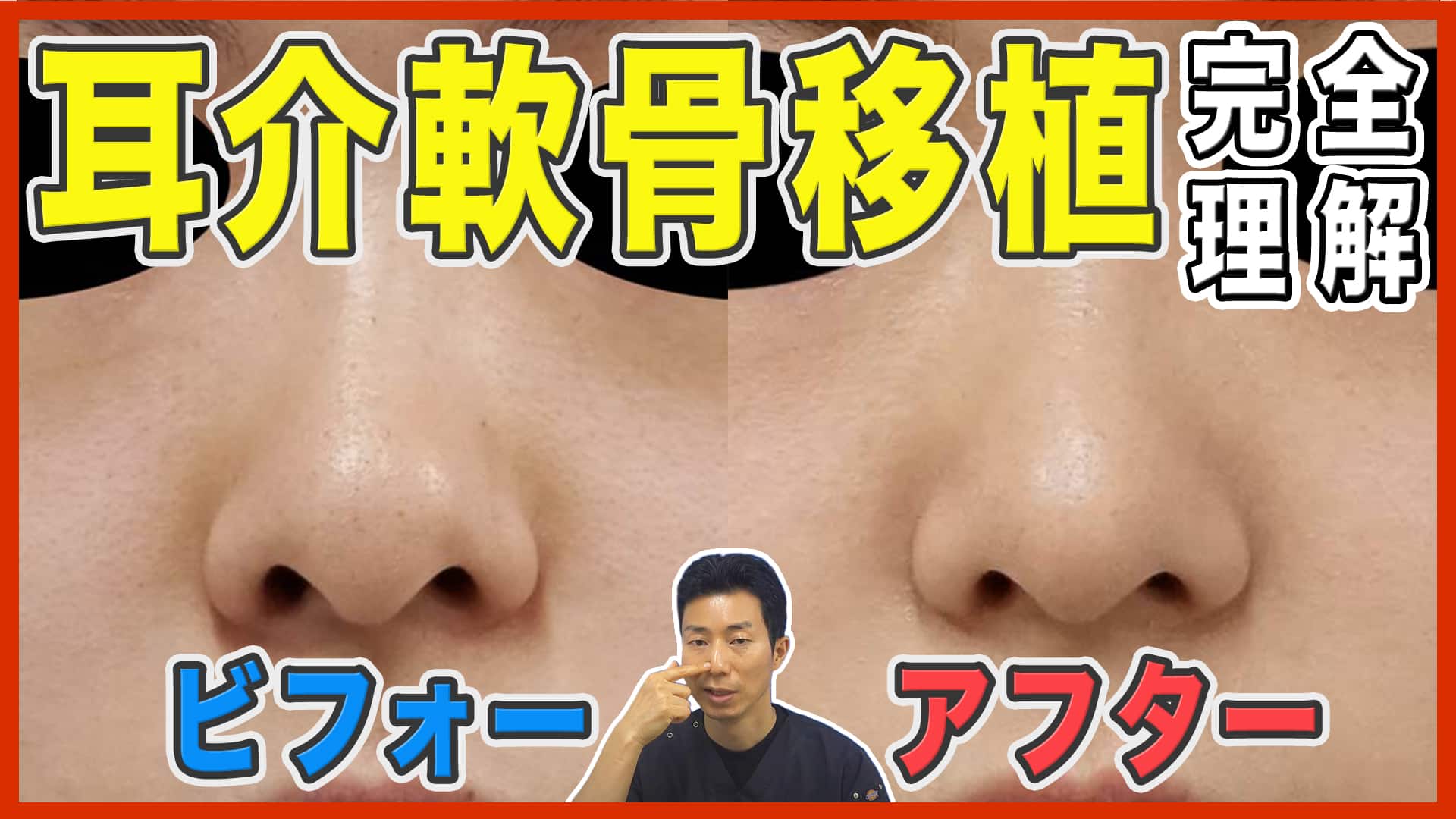 【鼻整形】耳介軟骨移植の症例写真を9症例一挙解説