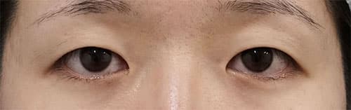目頭切開（Z形成）、二重埋没法（もとびアイプラチナム）　１か月後のBefore写真