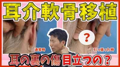 鼻整形の耳介軟骨移植の耳介軟骨って？耳の軟骨？耳のどこから軟骨を採取する？傷は目立たない？
