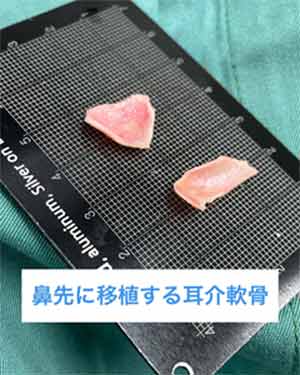 鼻の整形、耳介軟骨移植って？耳介軟骨移植の効果とリスク・失敗について　鼻先に移植する耳介軟骨