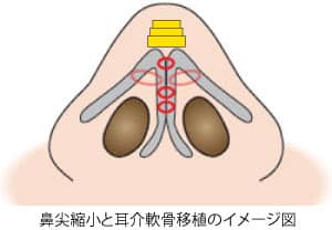 鼻尖縮小をおこなわずに軟骨移植だけおこなうことはできる？　鼻尖縮小と耳介軟骨移植のイメージ図