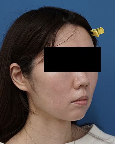ミントリフトミニフレックス１０本、脂肪溶解注射（チンセラプラス）　１か月後　右斜めのAfterの写真