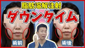 切らずに小顔になりたい!お顔の脂肪を切らずに取りたい!方は知っておきたい小顔脂肪溶解注射のダウンタイム