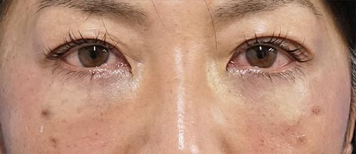 目の下のクマとり。目の下脂肪取り＋コンデンス脂肪注入（目の下）　手術直後　のAfterの写真