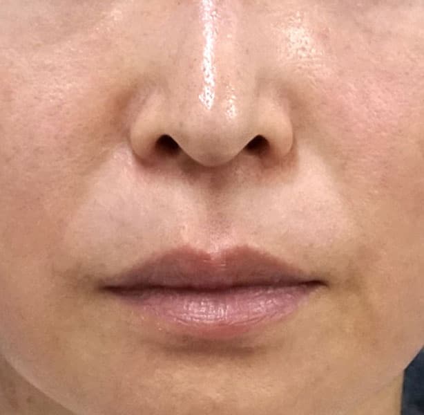人中短縮（リップリフト）　１週間後のBefore写真