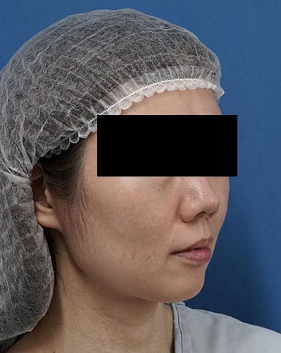 ミントリフトミニフレックス１０本、脂肪溶解注射（チンセラプラス）　１か月後　右斜めのBefore写真