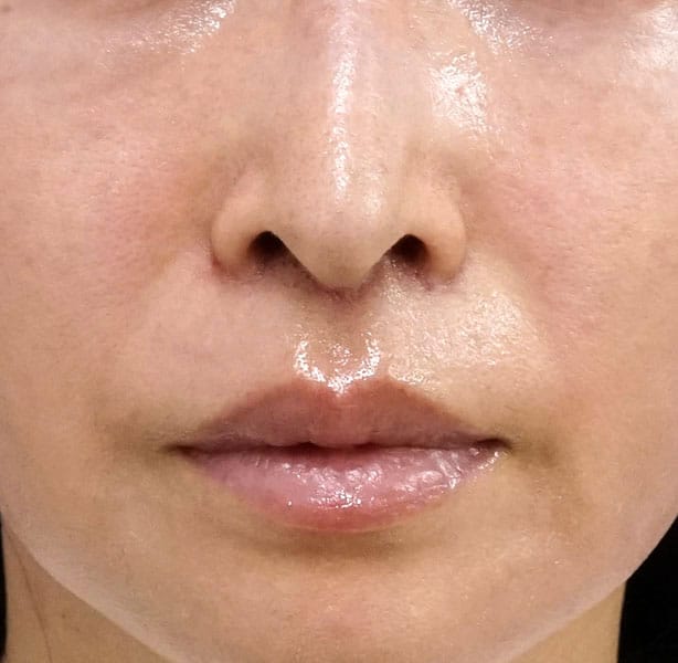 人中短縮（リップリフト）　１週間後のAfterの写真