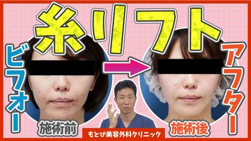 【糸リフト（たるみ改善・小顔）のビフォー・アフター】糸リフトの症例写真を用いて効果を解説！