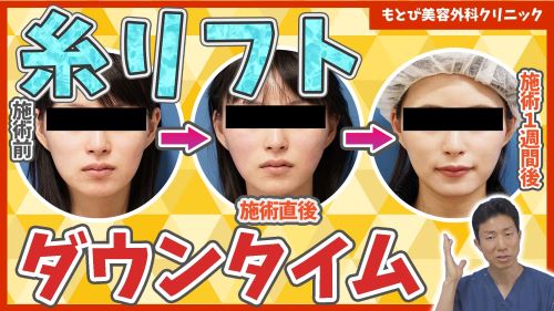 【糸リフトのダウンタイム・直後・1週間後】手術後のダウンタイムの経過や腫れを解説！