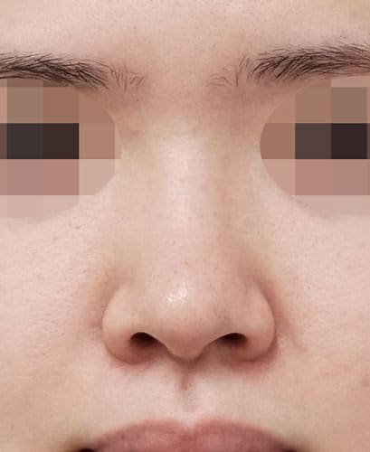 自然な感じで鼻先を細く高く(鼻尖縮小、耳介軟骨移植)6ヶ月後 正面のAfterの写真