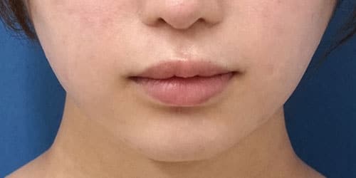 口角挙上術 7ヶ月後のAfterの写真
