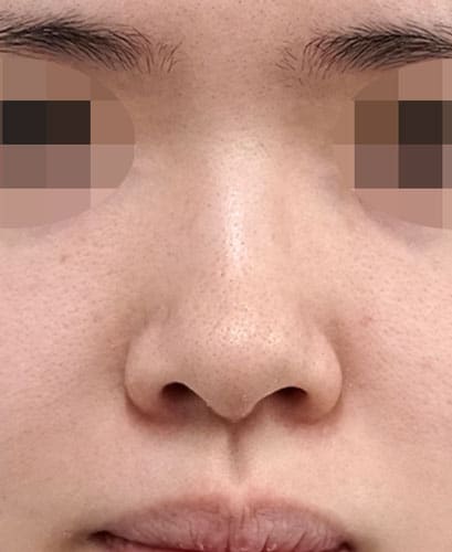 自然な感じで鼻先を細く高く(鼻尖縮小、耳介軟骨移植)6ヶ月後 正面のBefore写真