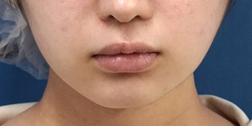 口角挙上術 7ヶ月後のBefore写真