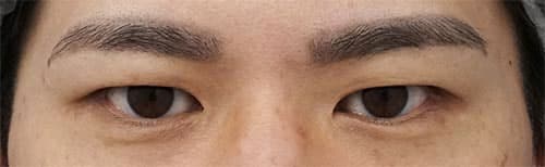 眉下切開 ３か月後のBefore写真