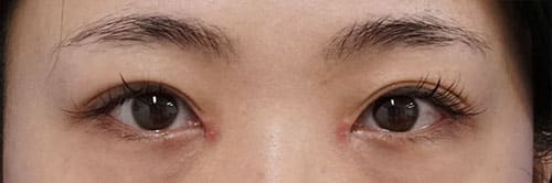 目頭切開Z形成 抜糸直後(7日後)のAfterの写真
