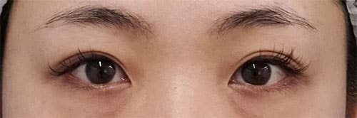 目頭切開Z形成　半年後のBefore写真