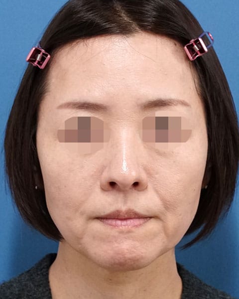人中短縮術　３か月後のAfterの写真