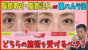 目の下のクマ取り整形は脂肪取り・脂肪注入と裏ハムラ法のどちらを選ぶべき?