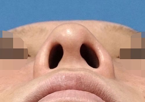 鼻尖縮小＋軟骨移植＋ストラット、鼻孔縁下降　１ヶ月後　下からのBefore写真